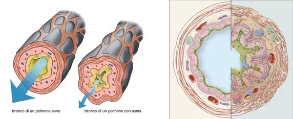 bronchi sani e bronchi con asma bronchiale