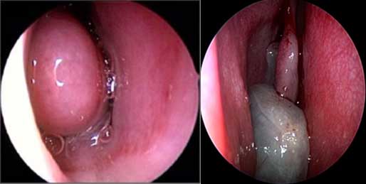 polipi-nasali