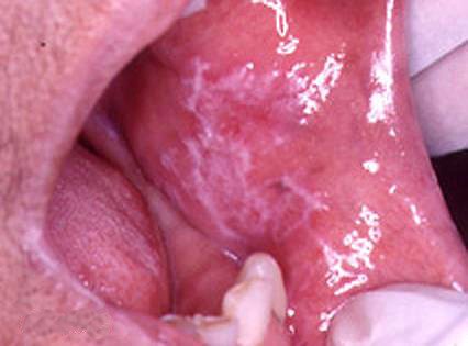 oral-lichen-planus