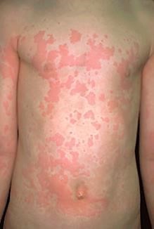 orticaria-generalizzata