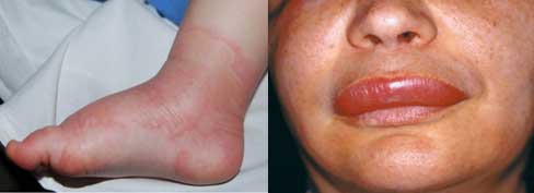 angioedema