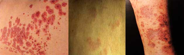 orticaria vasculite