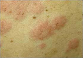 orticaria